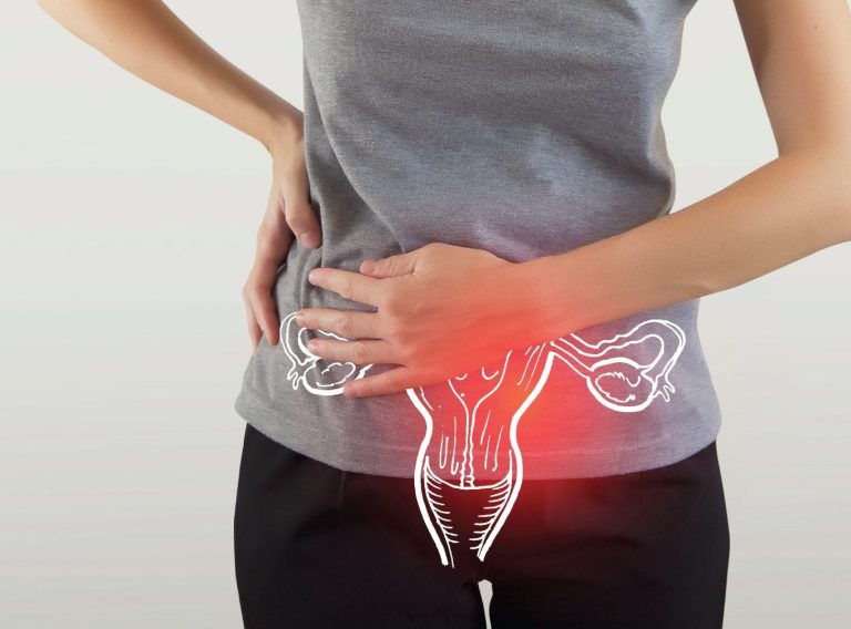 PCOS image PCOS image